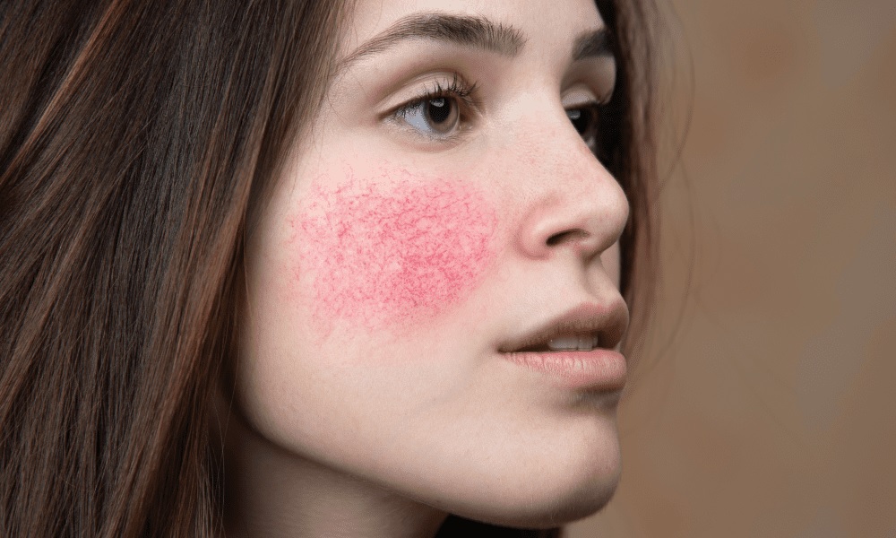 Rosacea What Are Its Causes and Symptoms